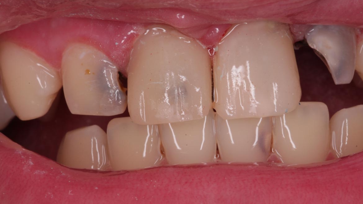 Profilaxia Cariei Dentare