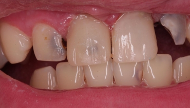 Profilaxia si Tratamentul Cariei Dentare